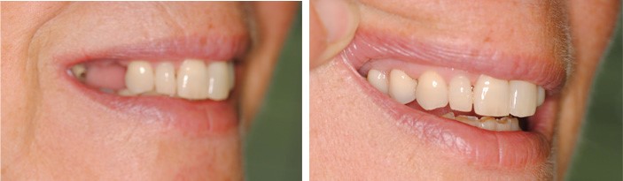 Before And After Dentures North Bennington VT 5257